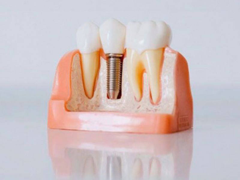 implantologia rehabilitacion vila real implantologia rehabilitacion vila real